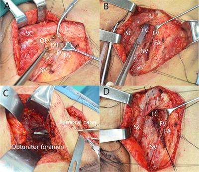 Deep Inguinal Lymph Node Metastases Can Predict Pelvic Lymph Node Metastases and Prognosis in Penile Squamous Cell Carcinoma